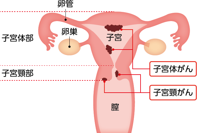 子宮がん説明図